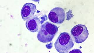 Transitional epithelial cells in urine cytology [upl. by Willcox]