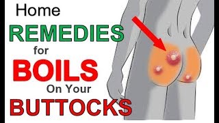 The 3 Most Effective Home REMEDIES for BOILS on BUTTOCKS  Boils BUTTOCKS Treatment for Fast Relief [upl. by Stockmon]