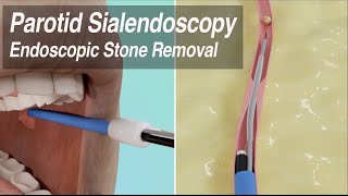 Parotid Sialendoscopy Endoscopic Duct Stenosis Balloon Dilation amp Salivary Stone Removal [upl. by Tarttan]