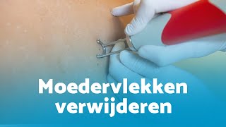 Moedervlekken verwijderen met laser in 2024 pijnloos en littekenvrij [upl. by Trepur]