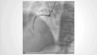 Decoding the NoReflow Phenomenon Coronary Microcirculations Role [upl. by Tootsie127]