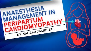 Anaesthesia Management In Peripartum Cardiomyopathy I Dr Nagesh Jambure [upl. by Nyladam860]