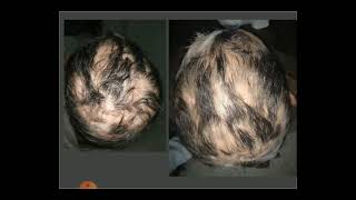 Dermoscopy of cicatricial alopecia 1 Dr Rania Al Akad Discoid Lupus of the scalp [upl. by Eeneg]