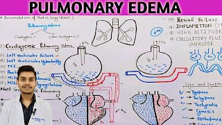 pulmonary edema pathophysiology in Hindi  cardiogenic pulmonary edema [upl. by Retsim]