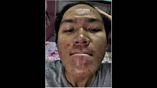 Acne update One month on doxycycline [upl. by Kuhn]