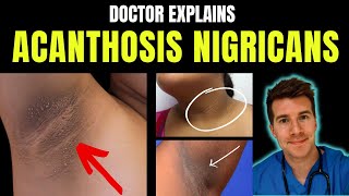 Doctor explains Acanthosis Nigricans  signs symptoms causes treatment and more [upl. by Acimahs]