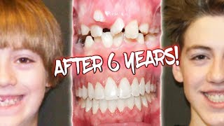 6 YEARS OF BRACES BEFORE AND AFTER TRANSFORMATION [upl. by Anirtap766]