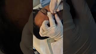 Retirada de sinal do nariz Nose mole removal [upl. by Kilar]