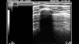 Normal lung vs pneumothorax [upl. by Ralph]