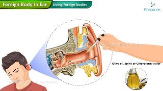 Foreign Body In The Ear 👂  ENT Lectures [upl. by Luht]