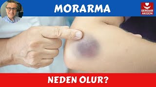 Morarma neden olur Sağlık ProfDrSerdar Akgün [upl. by Ynaffik]