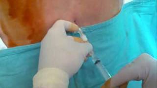 CSE combined spinal epidural anaesthesia needle to needle tecnique [upl. by Ahsai]