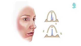 Rhinoplasty Detailed animation about the operation [upl. by Neelyad]