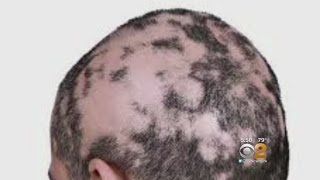 Dr Max Gomez Alopecia Treatment [upl. by Liatrice]