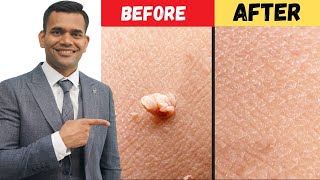 Remove Skin Tags and Warts Within 24 Hours  DrVivek Joshi [upl. by Silenay]