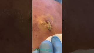 Draining a Massive Abscess [upl. by Kate]