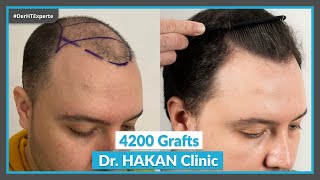 Haartransplantation bei einer Glatze  Vorher Nachher 4200 Grafts Dr HAKAN Clinic [upl. by Nitsua]