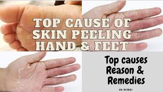 Palm skin peeling in hindi  palm peeling in Summer  Skin peeling treatment at home [upl. by Gearalt]