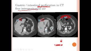 L7 Radiology GIT imaging RLM 41 [upl. by Sherie]