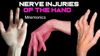 Claw HandWrist DropApe Hand in Urdu and HindiNerves injuries of the hand Nerve mbbsusmile [upl. by Einnor]