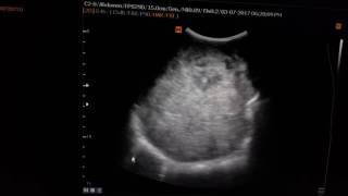 Neuroblastoma Sonography [upl. by Tra]