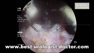 Enlarged Prostate Treatment In Bangalore  Laser TURP Surgery Karnataka  Prostate Surgery in India [upl. by Annaek344]