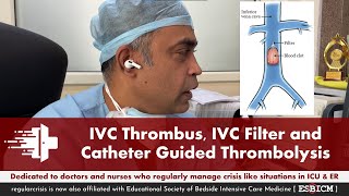 IVC Thrombus IVC Filter and Catheter Guided Thrombolysis  ESBICM [upl. by Annahsor968]