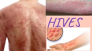 HIVES causes  Natural remedies to get rid of hive at home [upl. by Hoang]