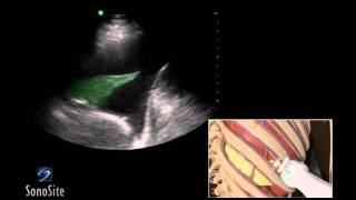 How To Ultrasound Guided Thoracentesis Exam 3D Video [upl. by Oivaf]