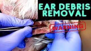 INSANE Ear Debris Debulking  CONTOUR DERMATOLOGY [upl. by Chuu]