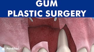 Gum plastic surgery  Laterally positioned flap for root coverage © [upl. by Landry]