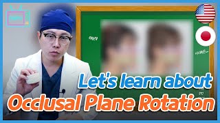 Lets learn about Occlusal Plane Rotation [upl. by Aiz]