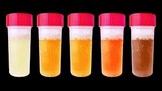 7 Choses Que Ton Urine Peut Révéler Sur ta Santé [upl. by Prader]