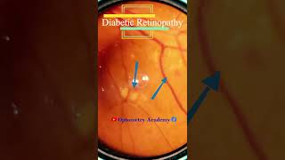 Diabetic retinopathy  Hemorrhages  cotton wool spots  Hard exudates  Fundus  Short Video 173 [upl. by Kyd936]