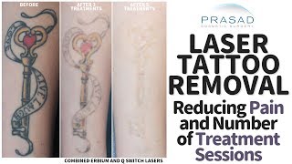 How Tattoos Removal can be Done with Less Pain and Fewer Treatment Sessions [upl. by Rosenblast916]