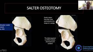 Pediatric Orthopaedics  Pelvic Osteotomies by Legendary Orthopedician ProfDrGopa Kumar TS [upl. by Saudra]