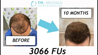 Haartransplantation Verlauf Vorher Nachher  Verdichtung ohne Rasur  3066 Grafts  1  10 Monate [upl. by Omixam]