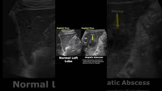 Hepatic Abscess On Ultrasound  Liver Normal Vs Abnormal USG  Abdominal Sonography shorts [upl. by Enomys482]