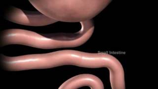 New York Methodist Hospital  Gastric Bypass [upl. by Alitha]