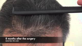 FUE Hair Transplant Hairline Clinic  DrOzgur 2500 GRAFTS DENSE PACKING 8 MONTHS LATER [upl. by Lledualc90]