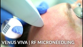 Skin Resurfacing Venus Viva Treatment for Wrinkles Pores and Texture  Live [upl. by Kirima1]