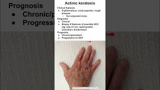 Actinic keratosis [upl. by Apps597]