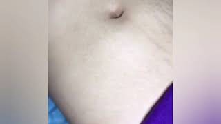 Plasma Fibroblast Stretch Marks Scars Treatment in Singapore [upl. by Florence]