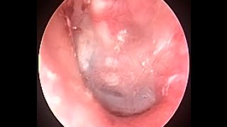 Suction Clearance 6 weeks after Tympanoplasty amp Mastoidectomy to see newly formed eardrum [upl. by Reinhold]