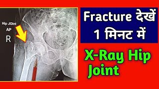 Fracture Proximal Femur Case 1  Intertrochanteric Fracture  XRay Hip Joint  UdayXray [upl. by Prue]