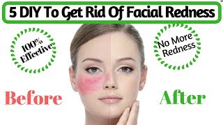 Natural Tips To Get Rid Of Facial Redness  How to Cure Red Irritated Skin  AVNI [upl. by Firestone]