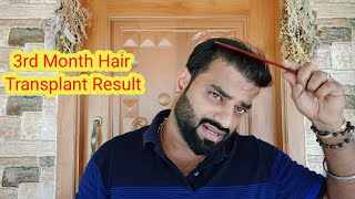 3rd Month hair Transplant Result Good or BadTamil Hair Transplant [upl. by Varuag]