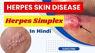 Herpes skin disease  herpes simplex virus  herpes  skin disease  genital herpes [upl. by True]