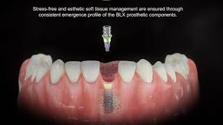 Straumann® BLX Consistent Emergence Profile [upl. by Daiz]