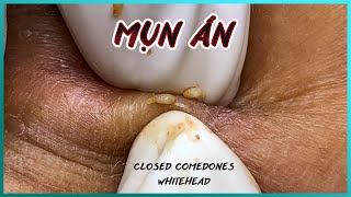 Big Cystic Acne Blackheads Extraction Blackheads amp Milia Whiteheads Removal Pimple Popping [upl. by Hsetirp]